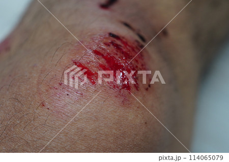 へま けが 負傷 114065079