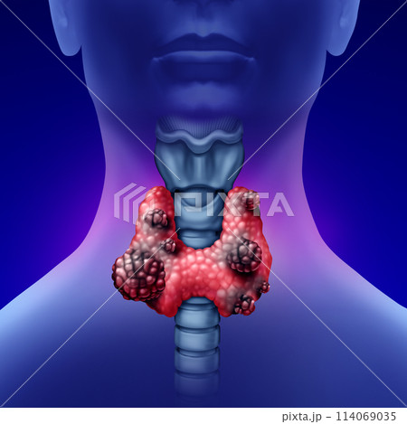 Cancer of the Thyroid Cancer of the Thyroid 114069035