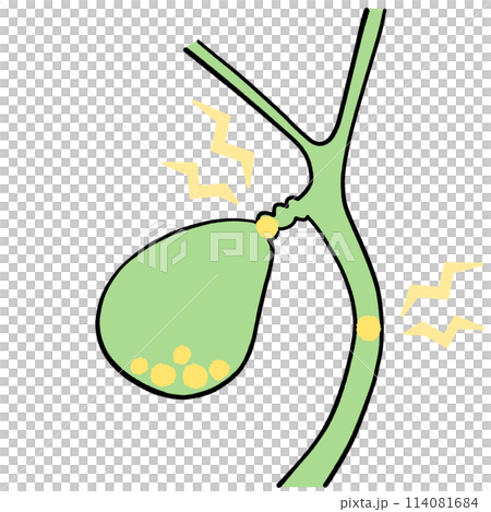 胆石のある胆嚢のイラスト 114081684