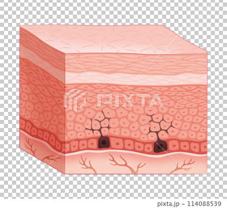 Cross-section of skin (mechanism of age spots) Cross-section of skin (mechanism of age spots) 114088539