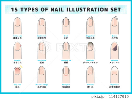 爪の病気・症状のイラストセット	 114127919