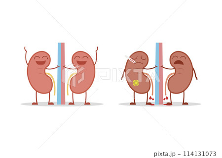 Healthy and sick kidneys isolated on white background vector illustration 114131073