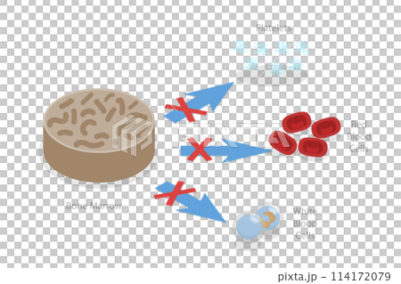 3D Isometric Flat Conceptual Illustration of Aplastic Anemia, Blood Disorder Causing Low Blood Cell Production 3D Isometric Flat Conceptual Illustration of Aplastic Anemia, Blood Disorder Causing Low Blood Cell Production 114172079