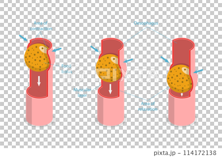 3D Isometric Flat  Conceptual Illustration of Peristalsis, Swallow Eating Problem 114172138