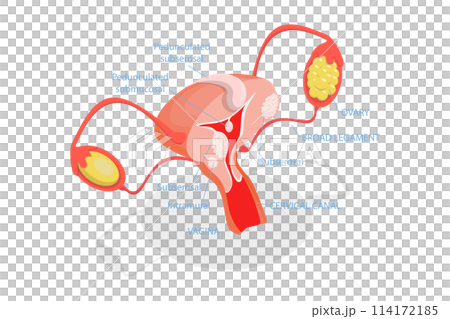3D Isometric Flat  Conceptual Illustration of Types Of Uterine Fibroids, Human Anatomy 114172185