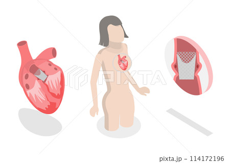 3D Isometric Flat Conceptual Illustration of Transcutaneous Aortic Valve Replacement - TAVR, Minimally Invasive Surgery 3D Isometric Flat Conceptual Illustration of Transcutaneous Aortic Valve Replacement - TAVR, Minimally Invasive Surgery 114172196