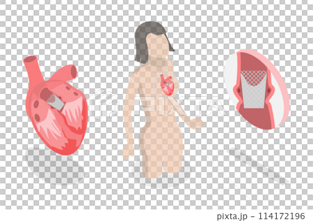 3D Isometric Flat  Conceptual Illustration of Transcutaneous Aortic Valve Replacement - TAVR, Minimally Invasive Surgery 114172196