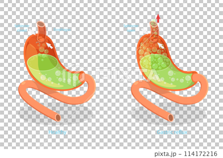 3D Isometric Flat  Conceptual Illustration of Stomach Reflux, Digestive System Problems 114172216