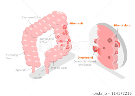 3D Isometric Flat  Conceptual Illustration of Diverticulitis, Medical Sructure and Location 114172219