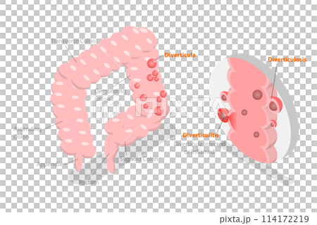 3D Isometric Flat  Conceptual Illustration of Diverticulitis, Medical Sructure and Location 114172219