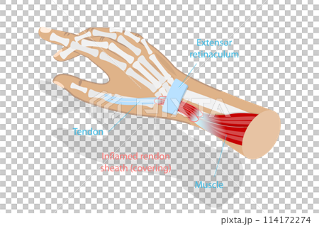 3D Isometric Flat  Conceptual Illustration of De Quervain Syndrome, Occupational Disease of the Hand 114172274