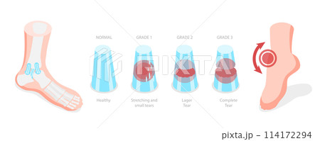 3D Isometric Flat  Conceptual Illustration of Grades Of Sprain, Ankle Problem 114172294