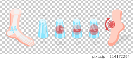 3D Isometric Flat  Conceptual Illustration of Grades Of Sprain, Ankle Problem 114172294