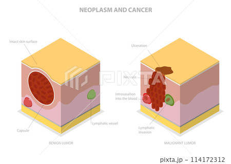 3D Isometric Flat  Conceptual Illustration of Neoplasm And Cancer, Tumor Development 114172312
