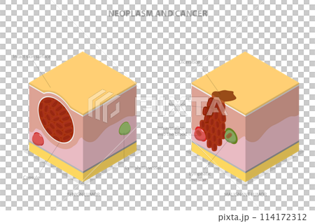 3D Isometric Flat  Conceptual Illustration of Neoplasm And Cancer, Tumor Development 114172312