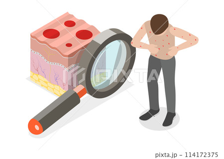 3D Isometric Flat Conceptual Illustration of Chickenpox, Red Rash 3D Isometric Flat Conceptual Illustration of Chickenpox, Red Rash 114172375