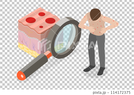 3D Isometric Flat Conceptual Illustration of Chickenpox, Red Rash 3D Isometric Flat Conceptual Illustration of Chickenpox, Red Rash 114172375