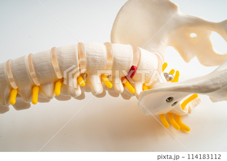 Lumbar spine displaced herniated disc fragment, spinal nerve and bone. Model for treatment medical in the orthopedic department. 114183112