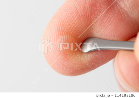 Damaged skin on finger with blister Damaged skin on finger with blister 114195186
