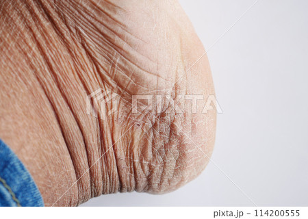 close up of young men dry feet  114200555