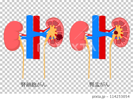 腎細胞癌和腎癌 114253054