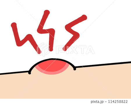 蚊に刺されのイラスト素材 114258822