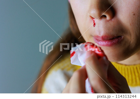 鼻血をティッシュ拭う女性 114313244