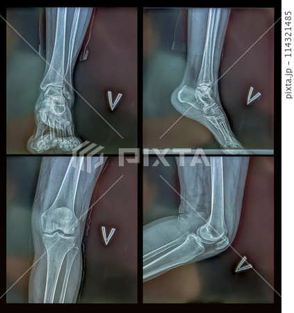 Collage of x-rays of the knee and ankle. Surgical medical technology concept Collage of x-rays of the knee and ankle. Surgical medical technology concept 114321485
