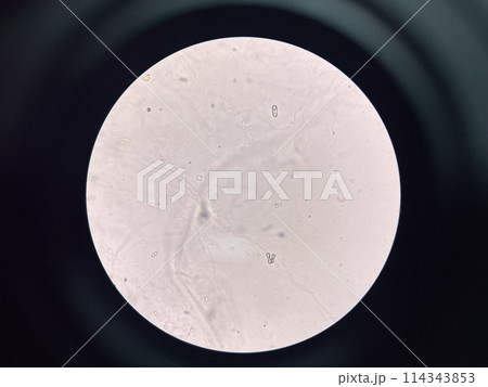 calcium oxalate crystal in urine. 114343853