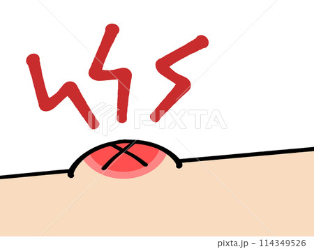 蚊に刺されのイラスト素材 114349526