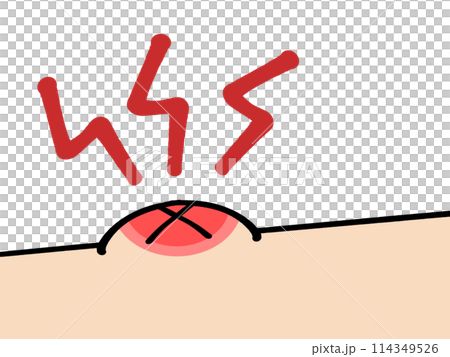 蚊に刺されのイラスト素材 114349526