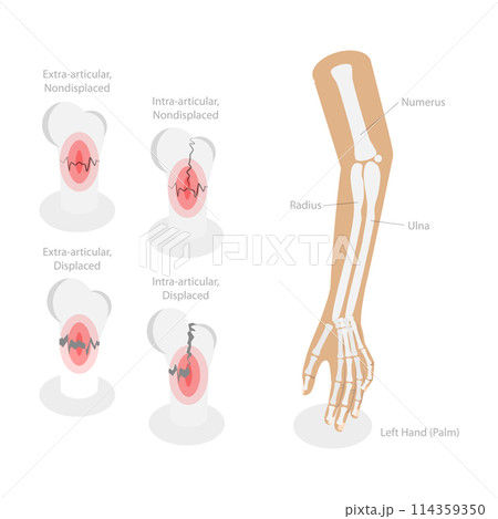 3D Isometric Flat  Conceptual Illustration of Distal Radius Fracture, Labeled Educational Diagram 114359350