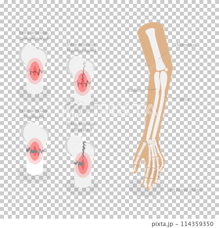 3D Isometric Flat  Conceptual Illustration of Distal Radius Fracture, Labeled Educational Diagram 114359350
