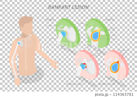 3D Isometric Flat Conceptual Illustration of Bankart Lesion, Educational Diagram 3D Isometric Flat Conceptual Illustration of Bankart Lesion, Educational Diagram 114363781