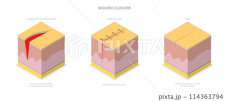 3D Isometric Flat  Conceptual Illustration of Wound Closure, Tissue Injury Healing 114363794