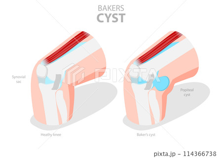 3D Isometric Flat  Conceptual Illustration of Bakers CYST, Traumatology and Prthopedics 114366738