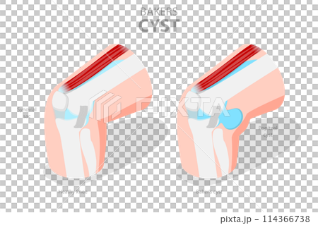 3D Isometric Flat  Conceptual Illustration of Bakers CYST, Traumatology and Prthopedics 114366738