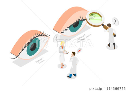 3D Isometric Flat  Conceptual Illustration of PTOSIS, Srooping of the Upper Eyelid 114366753