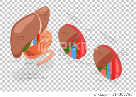 3D Isometric Flat  Conceptual Illustration of Gallbladder Removal Surgery, Cholecystectomy 114366780