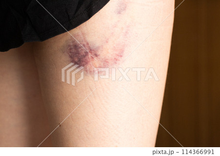 太ももの付け根にできた大きな青あざ 女性の足の打ち身 太ももの付け根にできた大きな青あざ 女性の足の打ち身 114366991