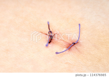 Medical suture with threads on the human body close-up Medical suture with threads on the human body close-up 114376985