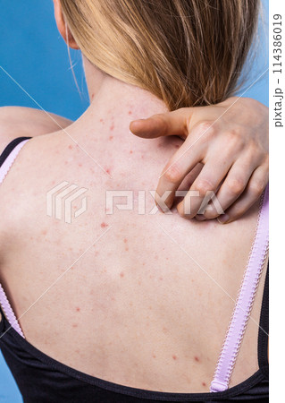 Woman with skin problem acne on back Woman with skin problem acne on back 114386019