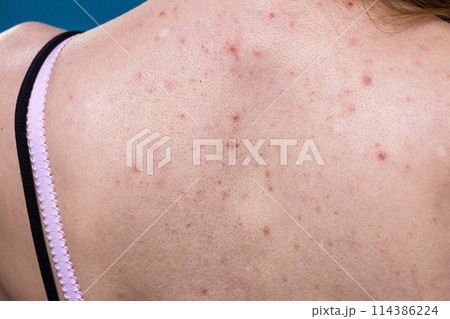 woman with skin problem acne on back 114386224