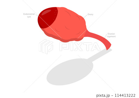 3D Isometric Flat  Conceptual Illustration of Endometrioma, Ovarian Cyst 114413222