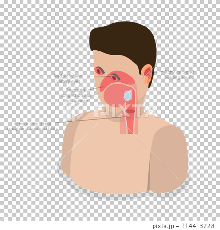 3D Isometric Flat Conceptual Illustration of Allergic Rhinitis, Labeled Educational Diagram 3D Isometric Flat Conceptual Illustration of Allergic Rhinitis, Labeled Educational Diagram 114413228