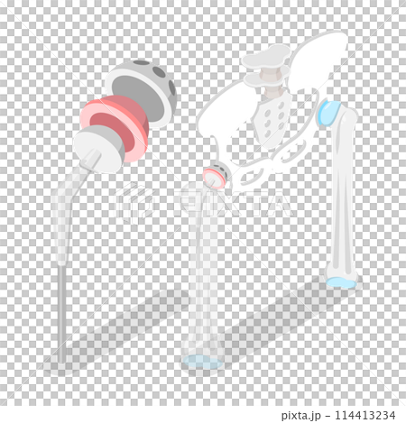 3D Isometric Flat  Conceptual Illustration of Total Hip Replacement, Joint Implant 114413234