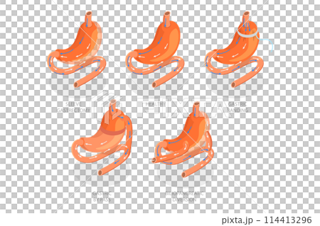 3D Isometric Flat  Conceptual Illustration of Types Of Bariatric Surgery, Sleeve Gastrectomy 114413296