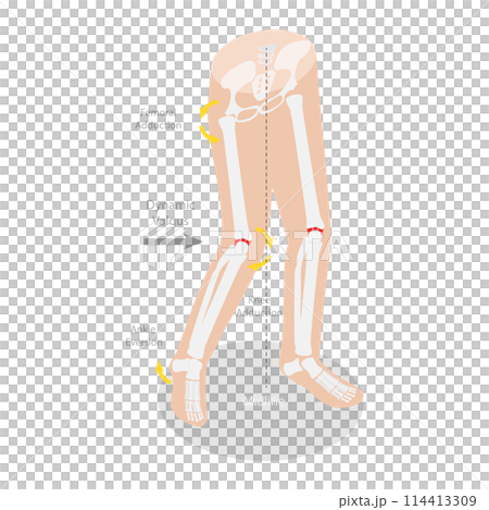 3D Isometric Flat  Conceptual Illustration of Mechanism Of Acl Injury, Labeled Educational Diagram 114413309