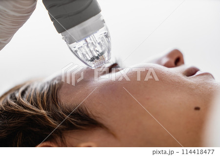 Microneedle RF lifting procedure. Hardware cosmetology. Microneedle RF lifting procedure. Hardware cosmetology. 114418477