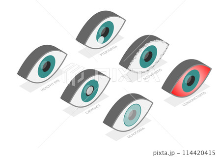 3D Isometric Flat Set of Eyes with Different Problems, Human Eye and Vision Health 3D Isometric Flat Set of Eyes with Different Problems, Human Eye and Vision Health 114420415